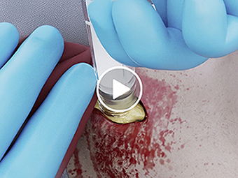 Traumagel Product Demo Video